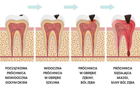 Leczenie Kana Owe Wo Omin Kliniki Stomatologioczne Piodent