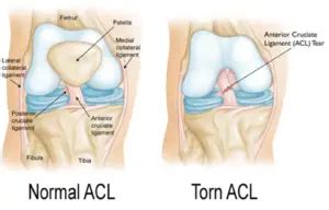 The 9 Best Exercises for ACL Injury Prevention in the Adolescent Female ...