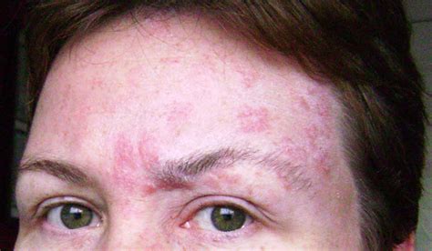 Pictures Of Shingles Rash Part 2 Shingles Expert