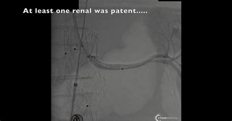 Urgent Treatment of Ruptured AAA in patient with COVID – Vascupedia