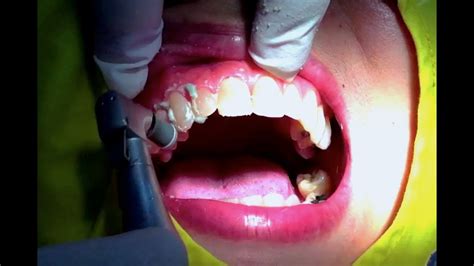 แมงกินฟัน ด้วยการขัดฟัน (Teeth Polishing) - YouTube