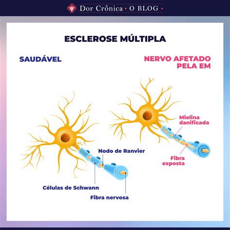 O Que Saber Sobre Desmieliniza O A For A Motriz Da Esclerose M Ltipla