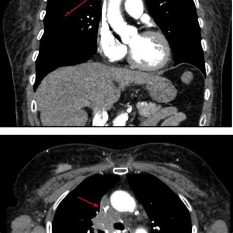 Colonoscopy Friable And Bleeding Tumor In The Colon Hepatic Flexure