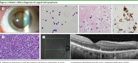 Ocular Lymphoma Semantic Scholar