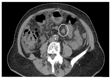 Diagnostics Free Full Text Peritoneal Carcinosis What The