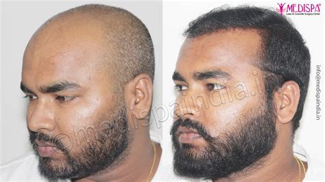 Hair Restoration Results Dubai Hair Transplant Dubai Cost