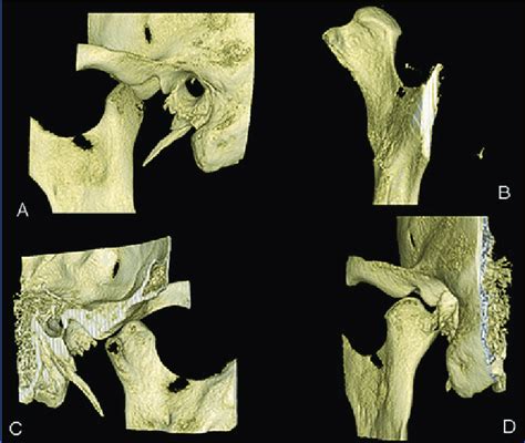 Three Dimensional Reconstruction Of The Condylar Process A Side Download Scientific Diagram