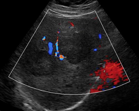 Liver Adenoma Ultrasound