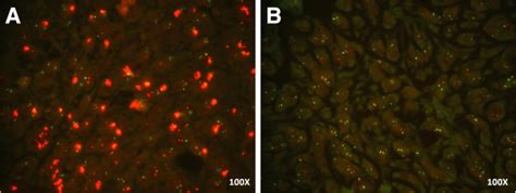 HER2 gene amplification by FISH. (A) Representative image of a positive ...