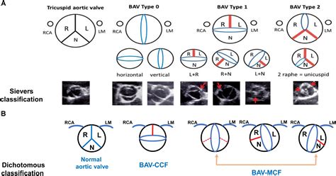 Right Aortic Valve