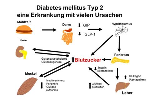 Was Ist Diabetes Mellitus Typ Diabetes News