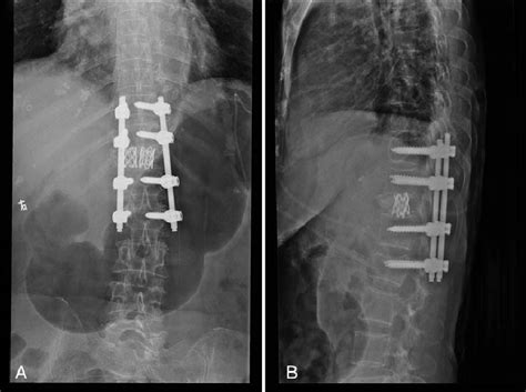 One Month Later Postoperative Posteroanterior A And Lateral B