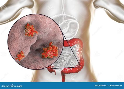 Entamoeba Histolytica Protozoan Stock Illustration 92764957