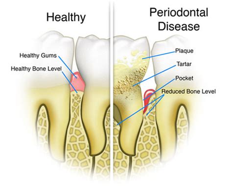 Scaling And Root Cleaning ADDC Dental Alexander Drive Dental Clinic