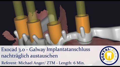 2021 Exocad 3 0 Tutorial Galway Implantatanschluss nachträglich