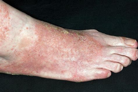 Infected Eczema On The Foot Photograph By Dr P Marazziscience Photo Library