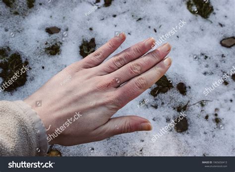 imagenes de chilblain imagenes fotos  vectores de stock