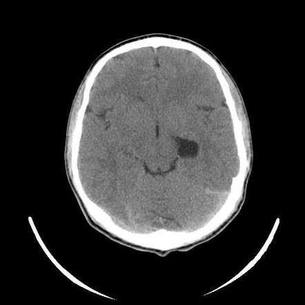 Choroidal fissure cyst | Radiology Reference Article | Radiopaedia.org