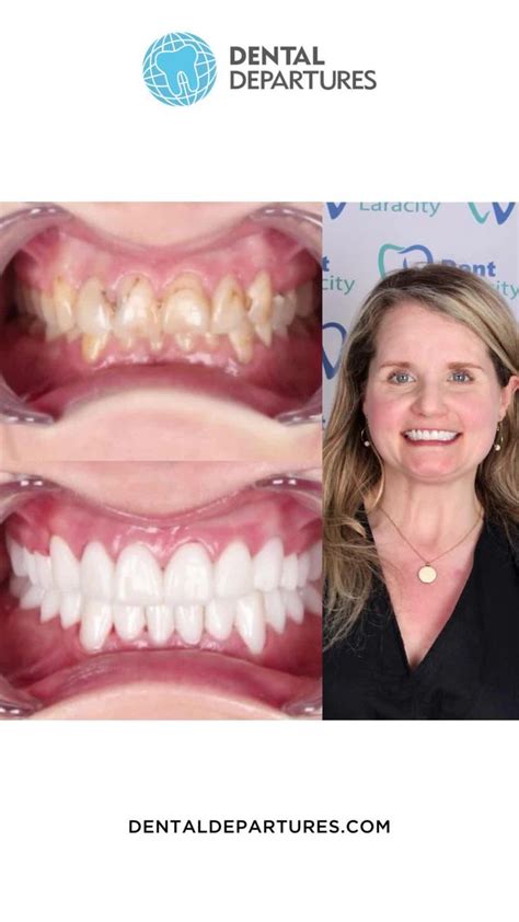 Chelsea From Canada Shares Her Dental Tourism Experience In Dent