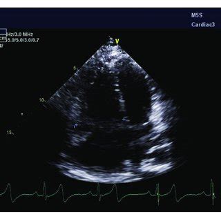 Transthoracic Echocardiogram | Download Scientific Diagram