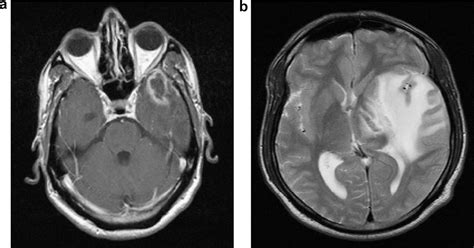 Figure 1 From Intracranial Syphilitic Gumma Resembling Malignant Brain