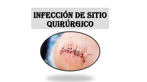 Infecci N De Sitio Quir Rgico Ela Salazar Udocz