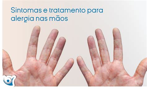 consultor lábio Sentimento de culpa dermatite de contato nas mãos