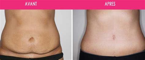 Abdominoplastie Correction Ventre Abim All En Tunisie