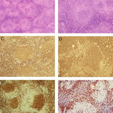 Mantle Cell Lymphoma Mcl In Situ And Sox11 Expression A A Case Of Download Scientific