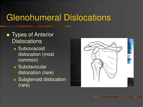 Ppt Dislocation And Fracture Reductions Powerpoint Presentation Free