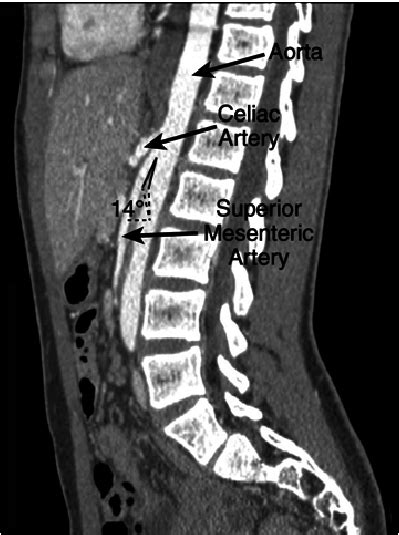 A Sagittal Image Of A Computed Tomography Ct Of Abdomen And Pelvis Download Scientific