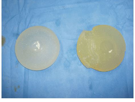 Implants Removed The Ruptured Implant Has A Slightly Yellow And Download Scientific Diagram