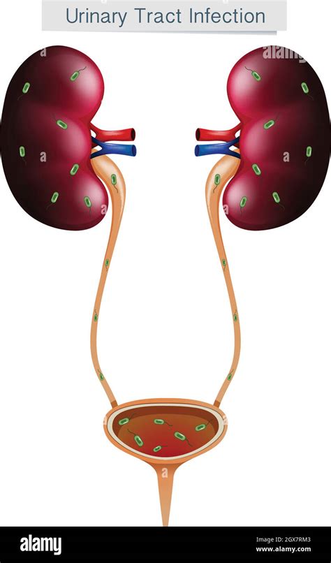 Infección Del Tracto Urinario Sobre Fondo Blanco Imagen Vector De Stock Alamy