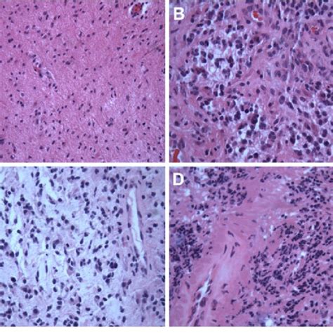 A Hematoxylin And Eosin Stained Section Of Brain Biopsy Specimen From