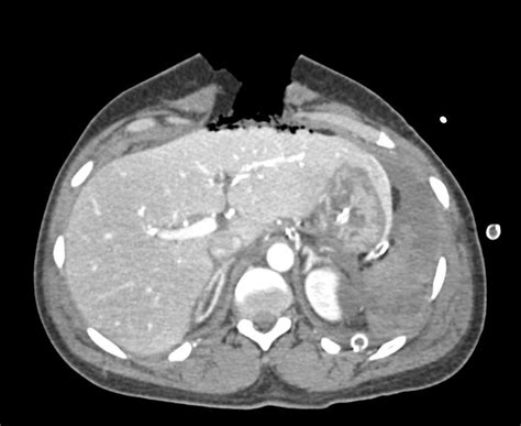 Hemoperitoneum Following Trauma With Open Wound Abdominal Wall And