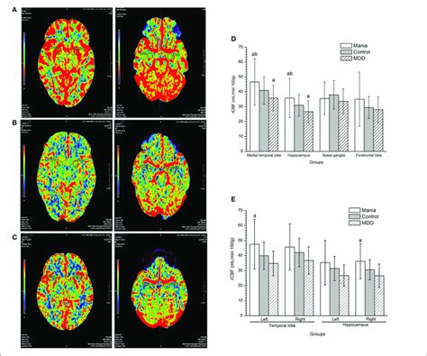 Comparisons Of Regional Cerebral Blood Flow Among The Mania