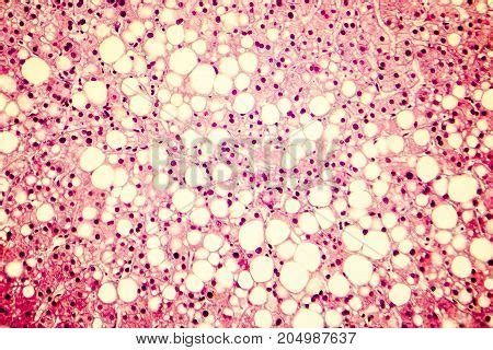 Fatty Liver, Liver Image & Photo (Free Trial) | Bigstock