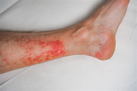 Eczema Enfermedad De La Piel En Las Piernas Erupciones Y Manchas Rojas