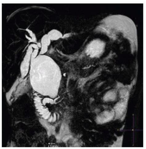 Operative Management Of Choledochal Cyst Basicmedical Key