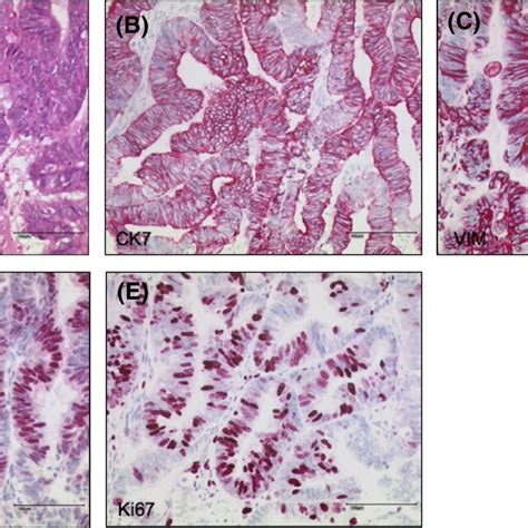 Histology And Immunohistochemistry Of Ovarian Cancer A H E Stain