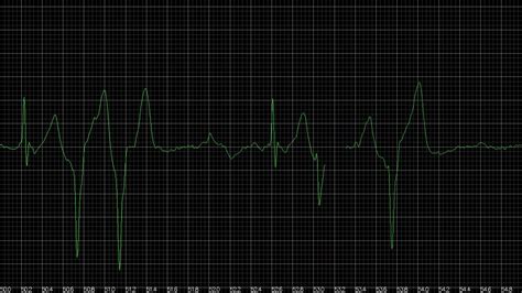 Female Heartbeat Under Pressure With Ecg Youtube