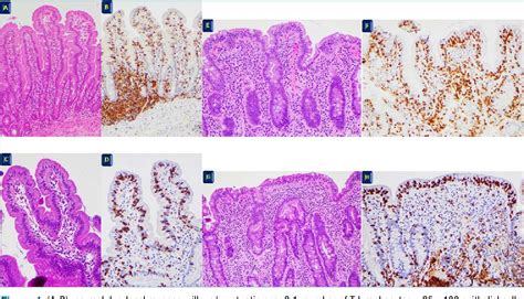 Figure 1 From Celiac Disease Histology Differential Diagnosis