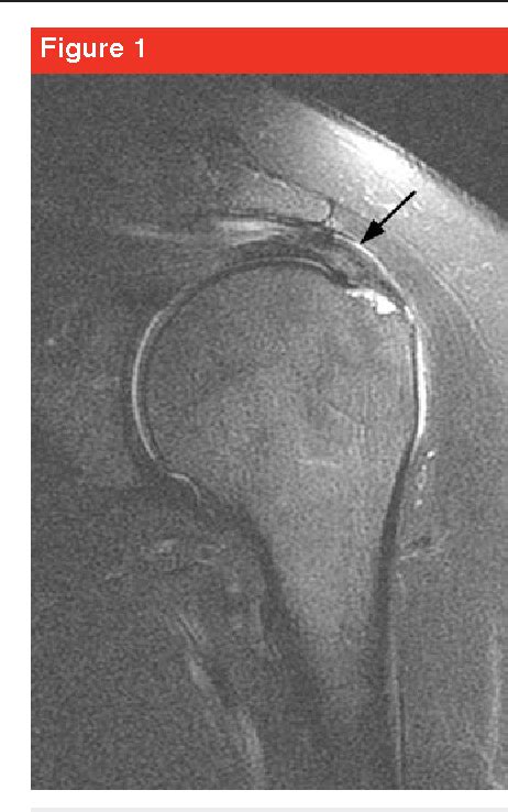 Figure From Subacromial Impingement Syndrome Semantic Scholar