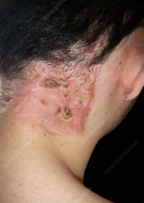 Hidradenitis Suppurativa Neck