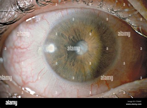 Glaucomatous Hi Res Stock Photography And Images Alamy