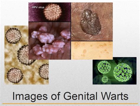 Hpv Genital Warts Disease Sexiz Pix