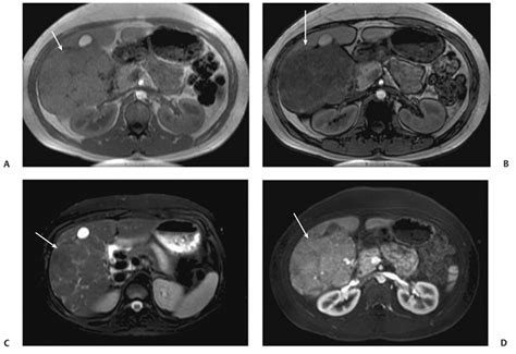 5 Pyogenic Liver Abscess | Radiology Key