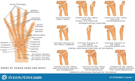 Hand And Wrist Fractures