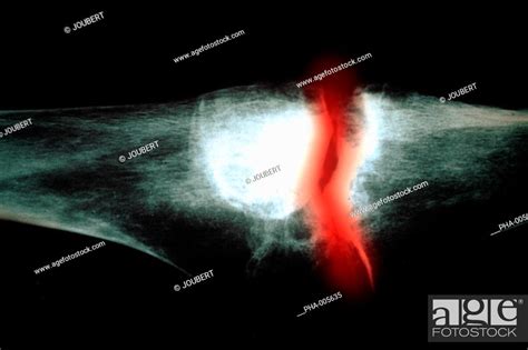 X Ray Of The Knee Affected By Chondrocalcinosis Characterized By The Calcification Of The