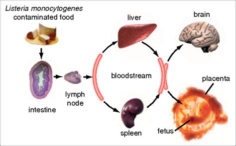 Infección por Listeria síntomas causas y tratamiento Medicina Básica